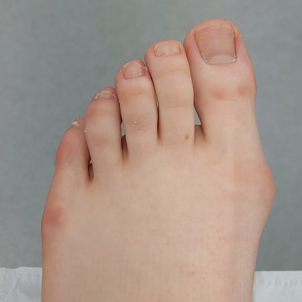 After Fungal nail infection treatment