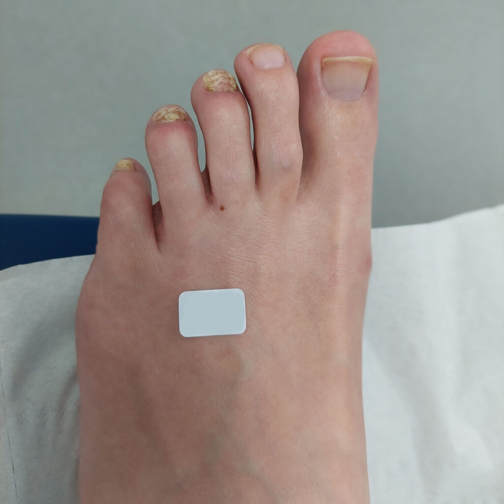 Before Fungal nail infection treatment