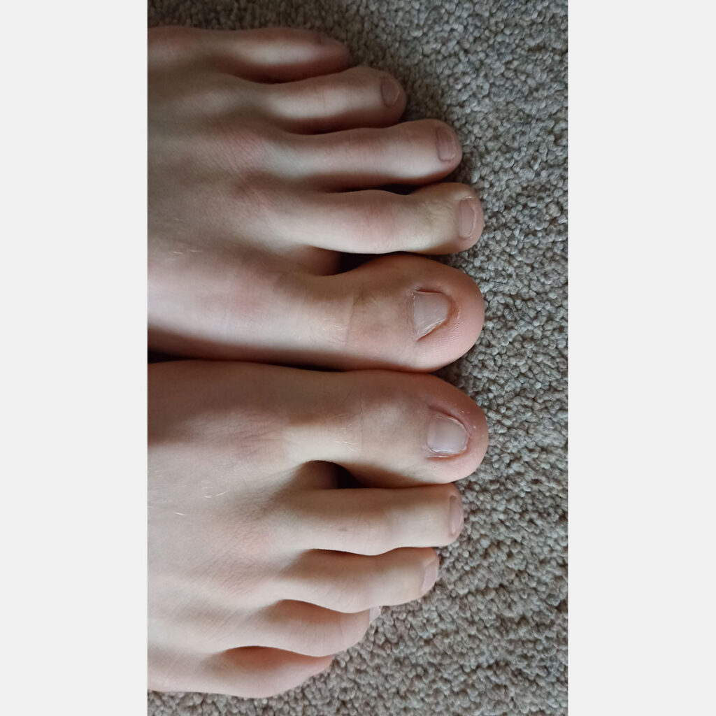 After Fungal nail infection treatment